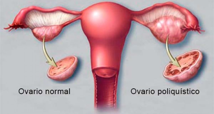 Ovarios Poliquísticos Ginemed Guadalajara Clínica De La Mujer Zapopan Ginemed Ginecologos 4655