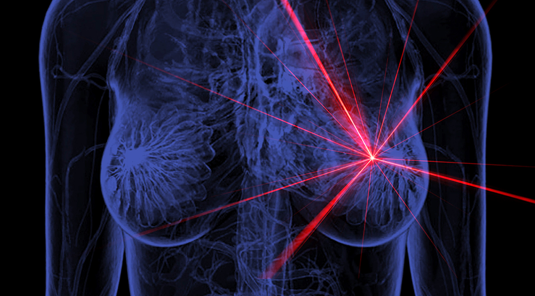 Nuevo Mamógrafo de Luz Infrarroja nuevo mamógrafo de luz infrarroja Nuevo Mamógrafo de Luz Infrarroja MAMOGRAFIA 3
