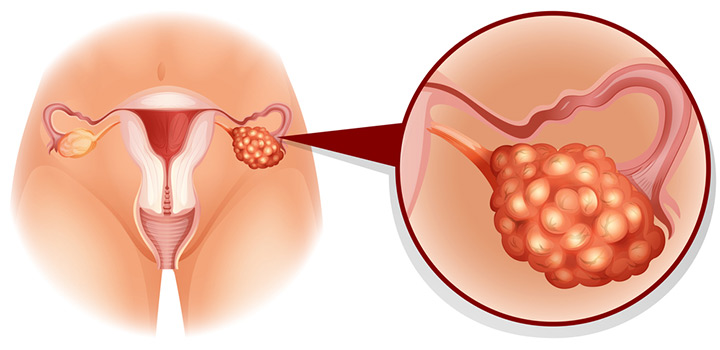 Síndrome De Ovario Poliquístico Zapopan Cambios Hormonales Ciclos Menstruales Clínica De 7760