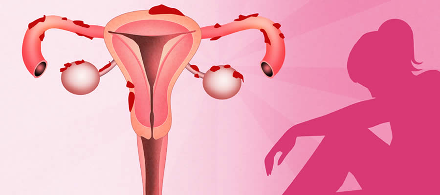 La Endometriosis Guadalajara Clínica Para La Mujer Guadalajara Ginecólogos En Guadalajara 9075