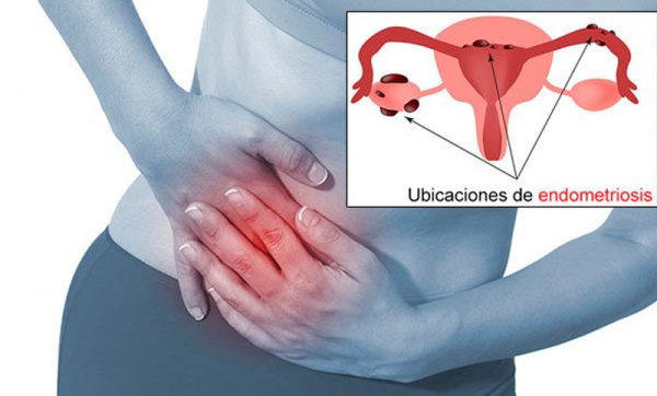 La Endometriosis Guadalajara Clínica Para La Mujer Guadalajara Ginecólogos En Guadalajara 4170