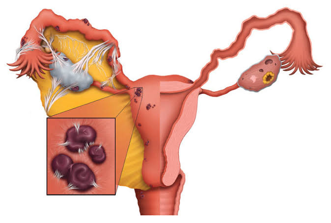 La Endometriosis Y Sus 3 Pilares Guadalajara Ginemed Guadalajara Clínica De La Mujer Zapopan 0968
