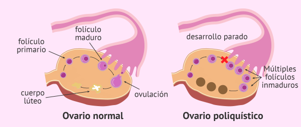Síndrome De Ovarios Poliquísticos Guadalajara Clínica Para La Mujer Guadalajara Ciclos 3811