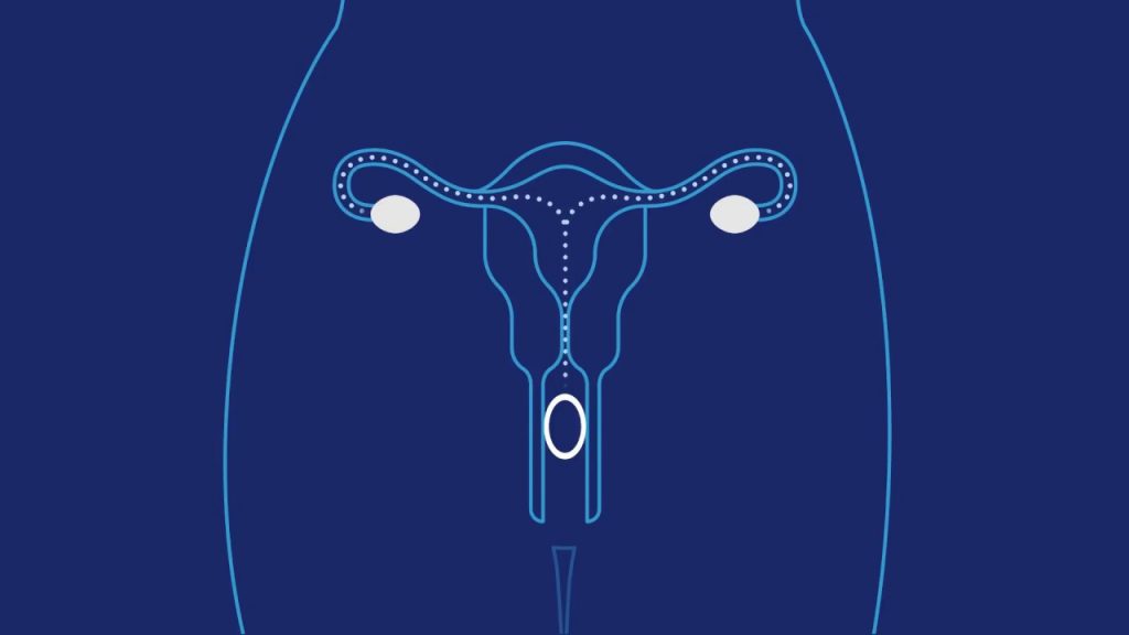 Anillo Vaginal Anticonceptivo En Guadalajara Clínica Para La Mujer Guadalajara Ginecólogos 6470