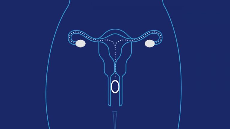 Anillo Vaginal Anticonceptivo En Guadalajara Clínica Para La Mujer Guadalajara Ginecólogos 9811