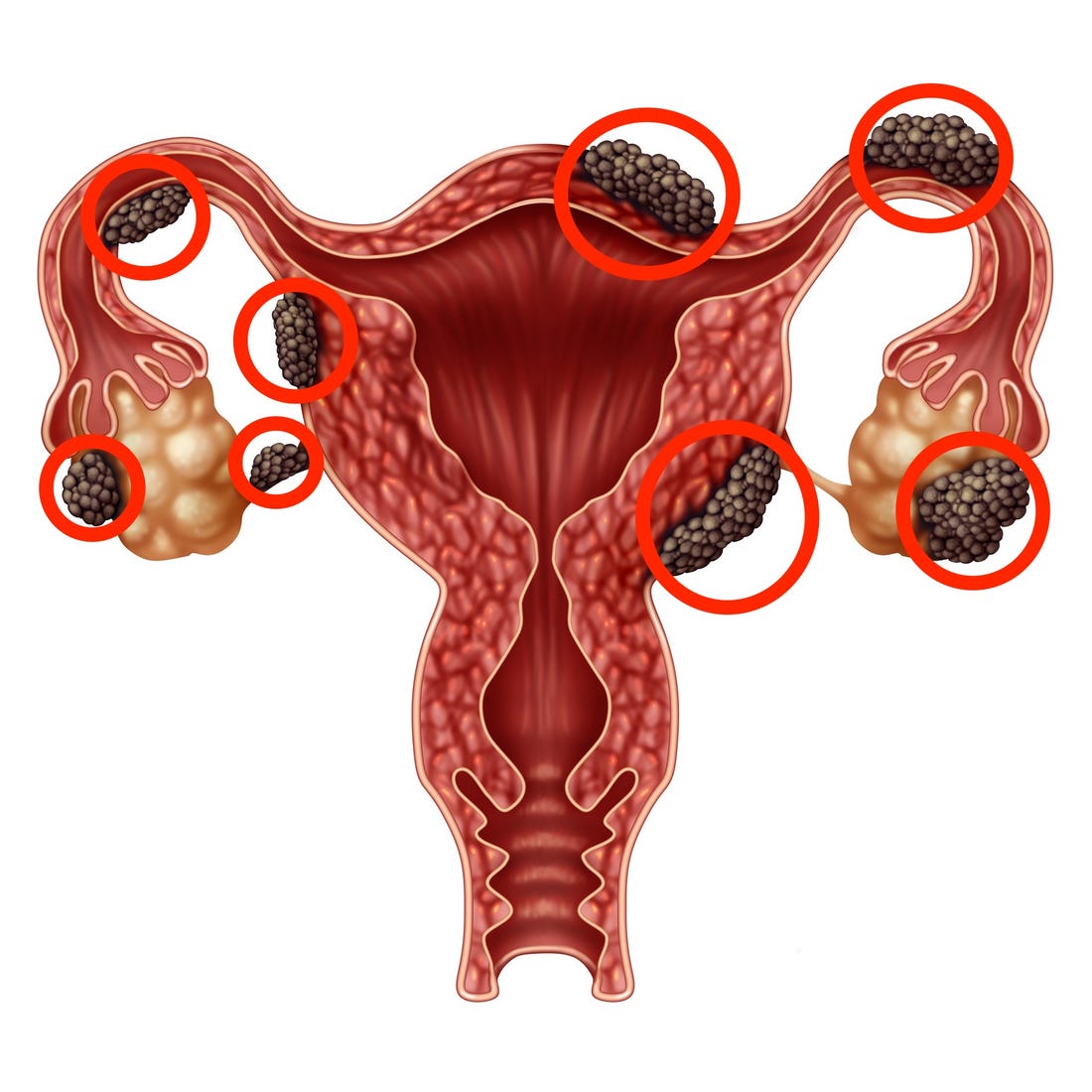 La Endometriosis En Guadalajara Clínica Para La Mujer En Guadalajara Ginecologos En 2924